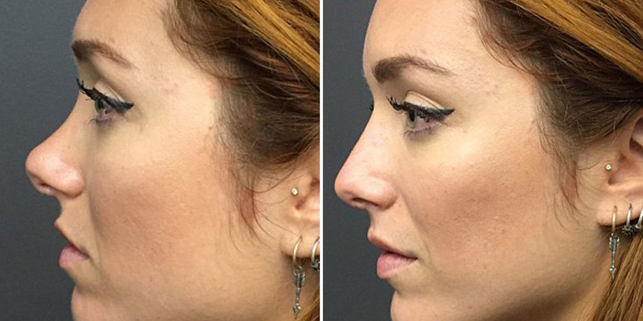 How a Plastic Surgeon Can Make This Nose Job Happen in 5 Minutes