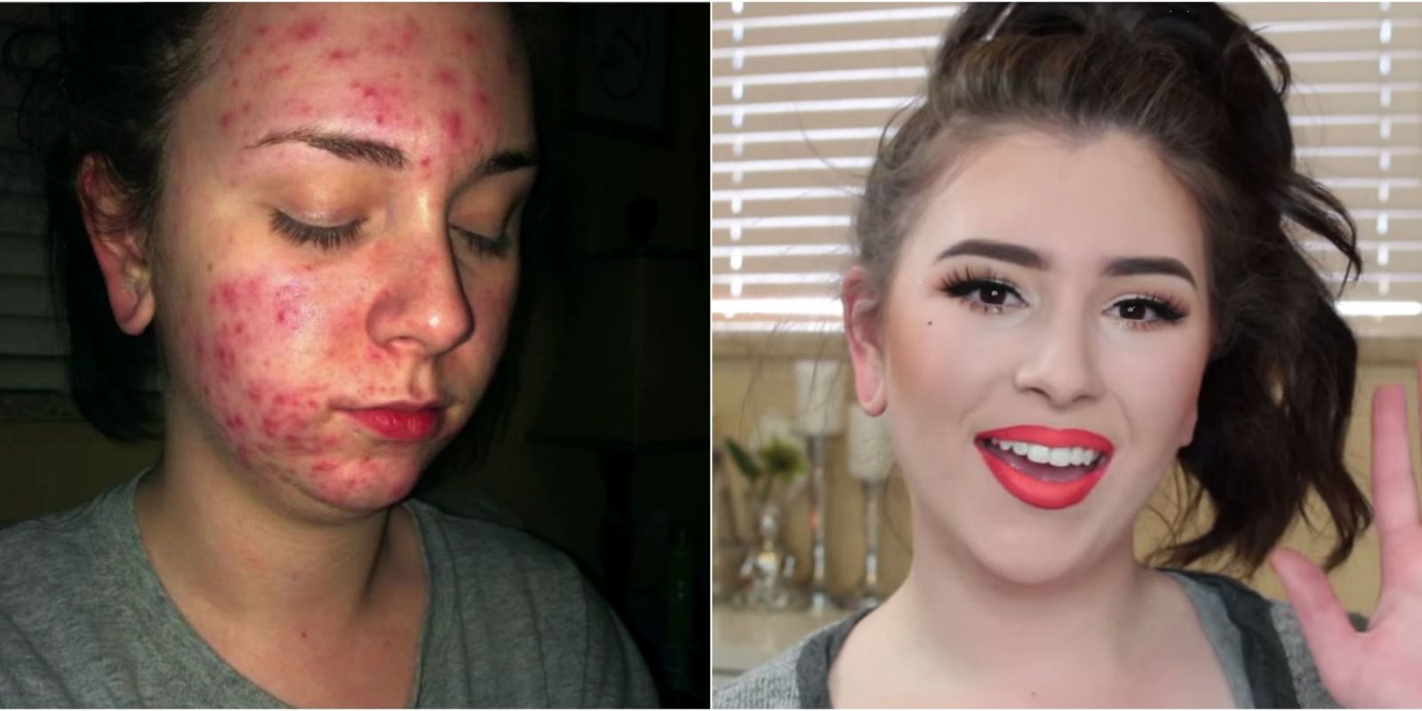 Cystic acne dating
